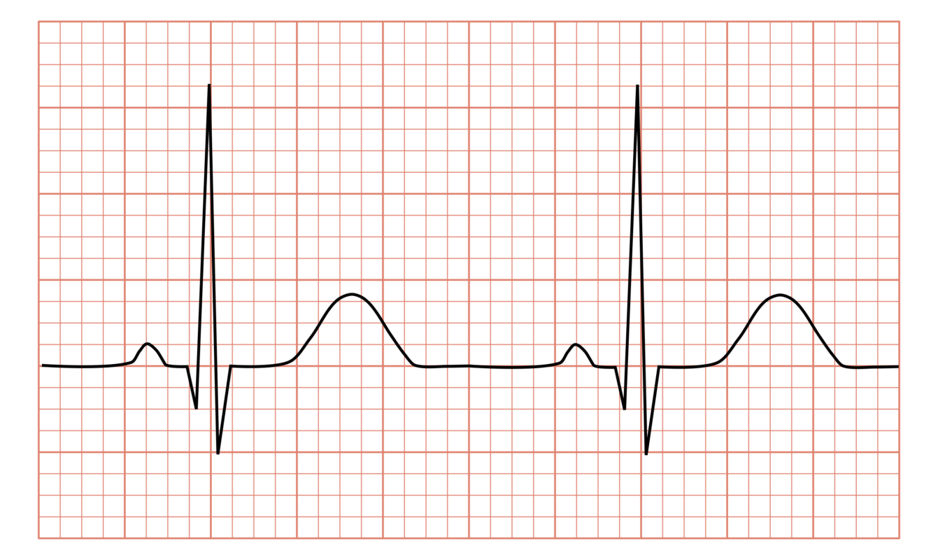 ECG Graph